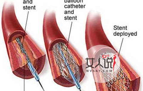 知道心脏支架是什么吗心脏支架适应症和费用