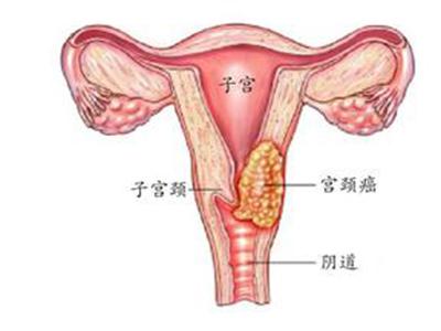 约有半数以上已婚女性患者有不同程度的宫颈糜烂,而没有性生活的女性