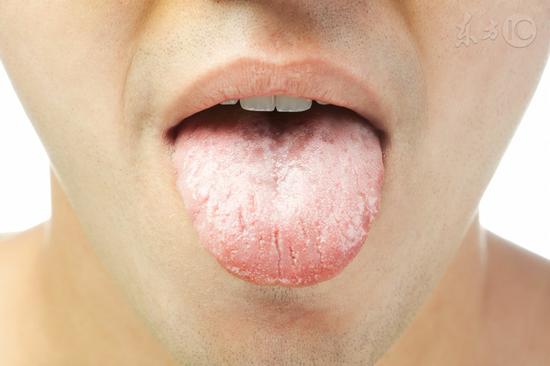 舌头颜色变化可能预示8种疾病
