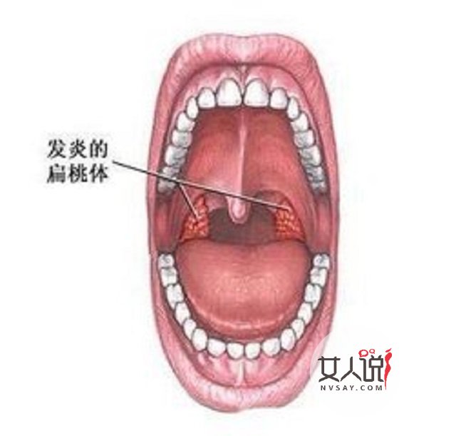 咽喉癌的早期症状图片