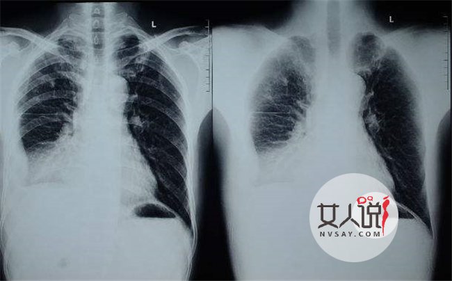 胸膜炎的早期症状图片