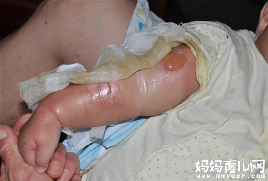 宝宝被烫伤的处理方法 家长注意视其烫伤程度适当处理