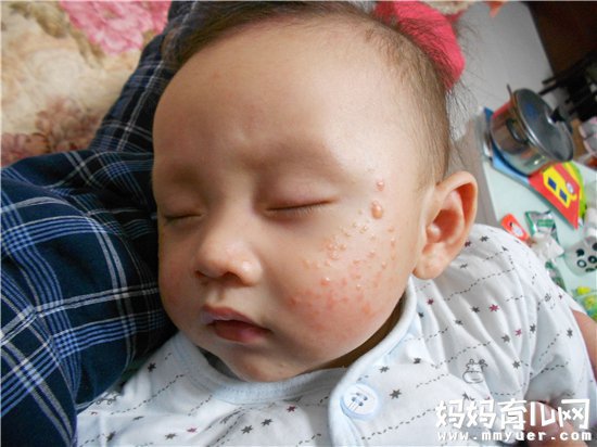秋季为婴儿湿疹高发季 如何预防秋季婴儿得湿疹