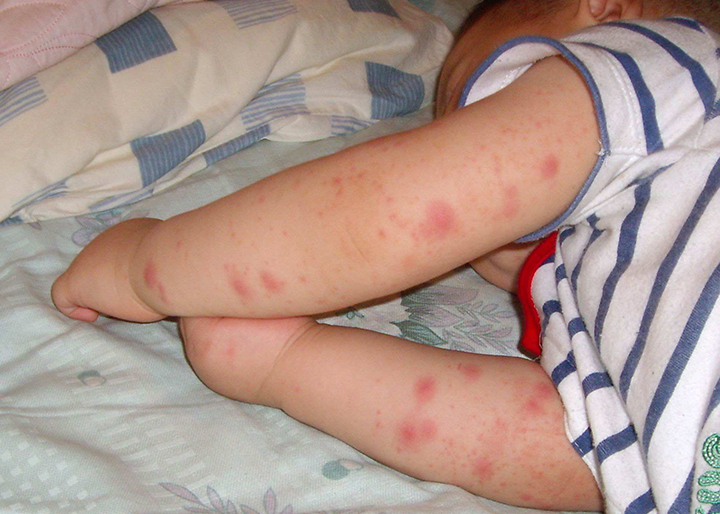 患儿湿疹部位的皮肤会出现起皮,粗糙,发红,呈片状的疹子,有些患儿的