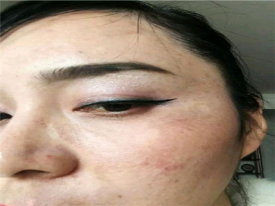 化妆品汞中毒症状图片图片