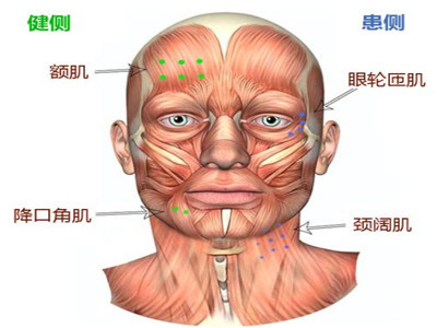 周圍性面神經麻痺的治療方法