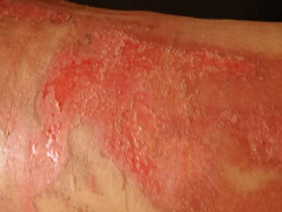 氢氟酸灼伤皮肤后图片图片