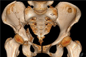 骨盆骨折會影響走路嗎