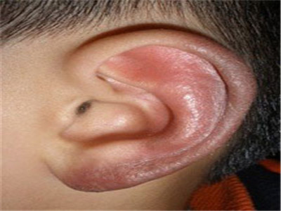 耳朵冻伤多由于体寒,难以抵抗寒冷所致,同时耳朵也是最容易冻伤的部位