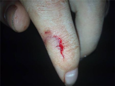 女生手指被刀割伤图片图片