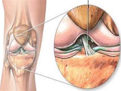 内侧副韧带损伤治疗