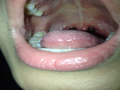 白喉是由白喉杆菌所引起的一种急性呼吸道传染病,其症状为发热,气憋
