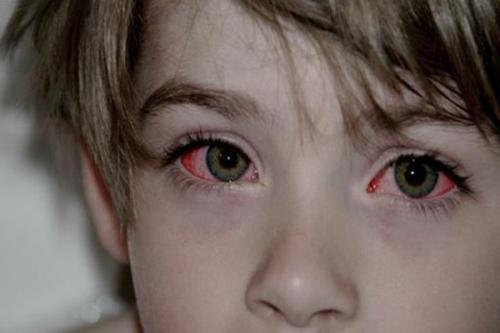 眼睛斜视的问题,下面就和小编一起去了解一下孩子红眼病该怎样预防