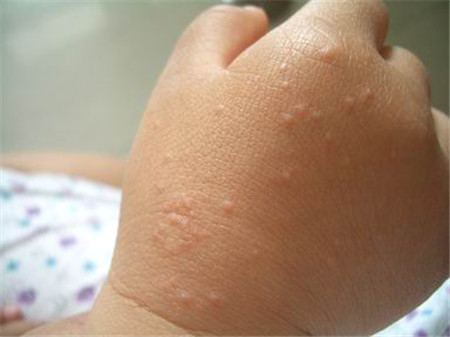 儿童过敏性皮炎 皮疹图片