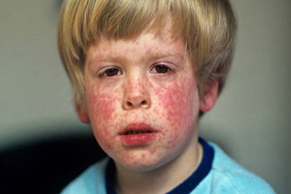 婴儿风疹的症状图片图片