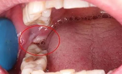 哪些情况需要拔掉智齿