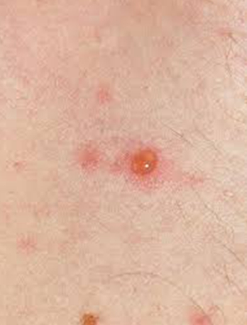 艾滋病的皮肤症状通常以黄斑,丘疹或疱疹为主要特征,2-3周后会自行