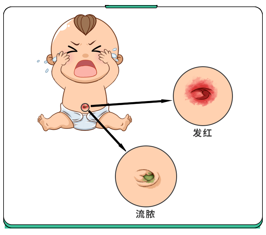宝宝脐带化脓怎么办图片